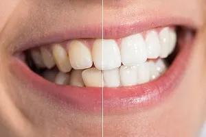 25433 types of teeth whitening