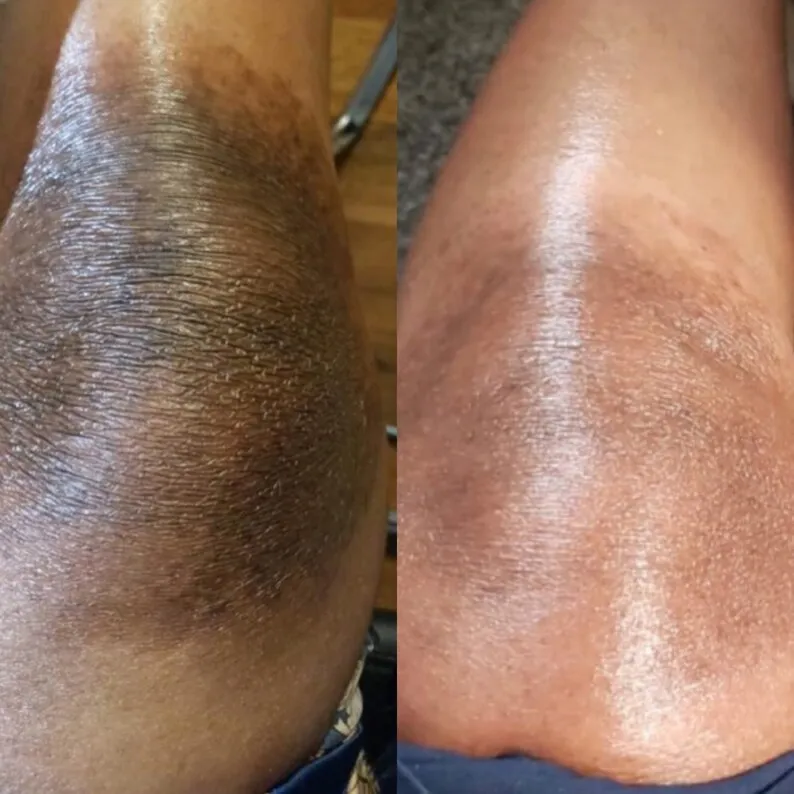 25436 whitening cream application