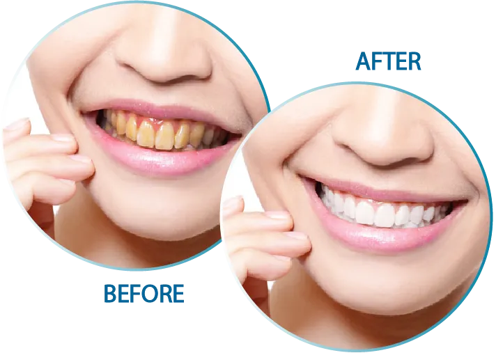 25438 in office teeth whitening