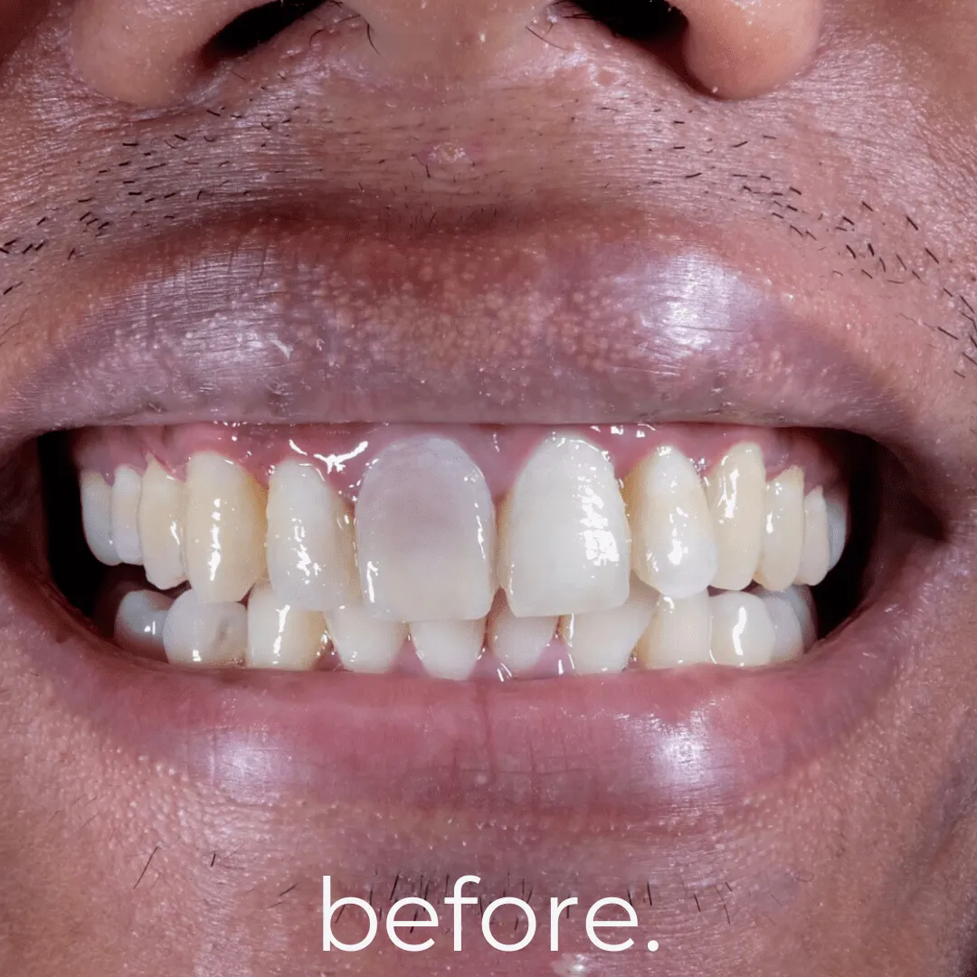 25438 teeth whitening aftercare