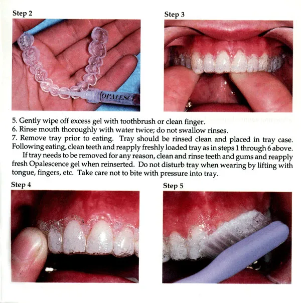 25439 teeth whitening process