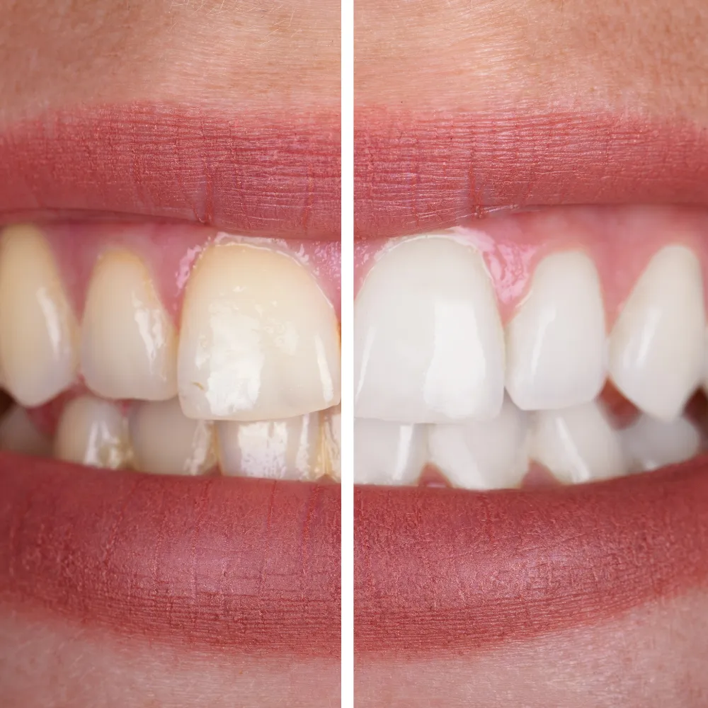 25456 at home teeth whitening