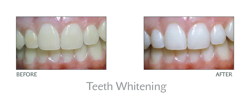 25456 in office teeth whitening