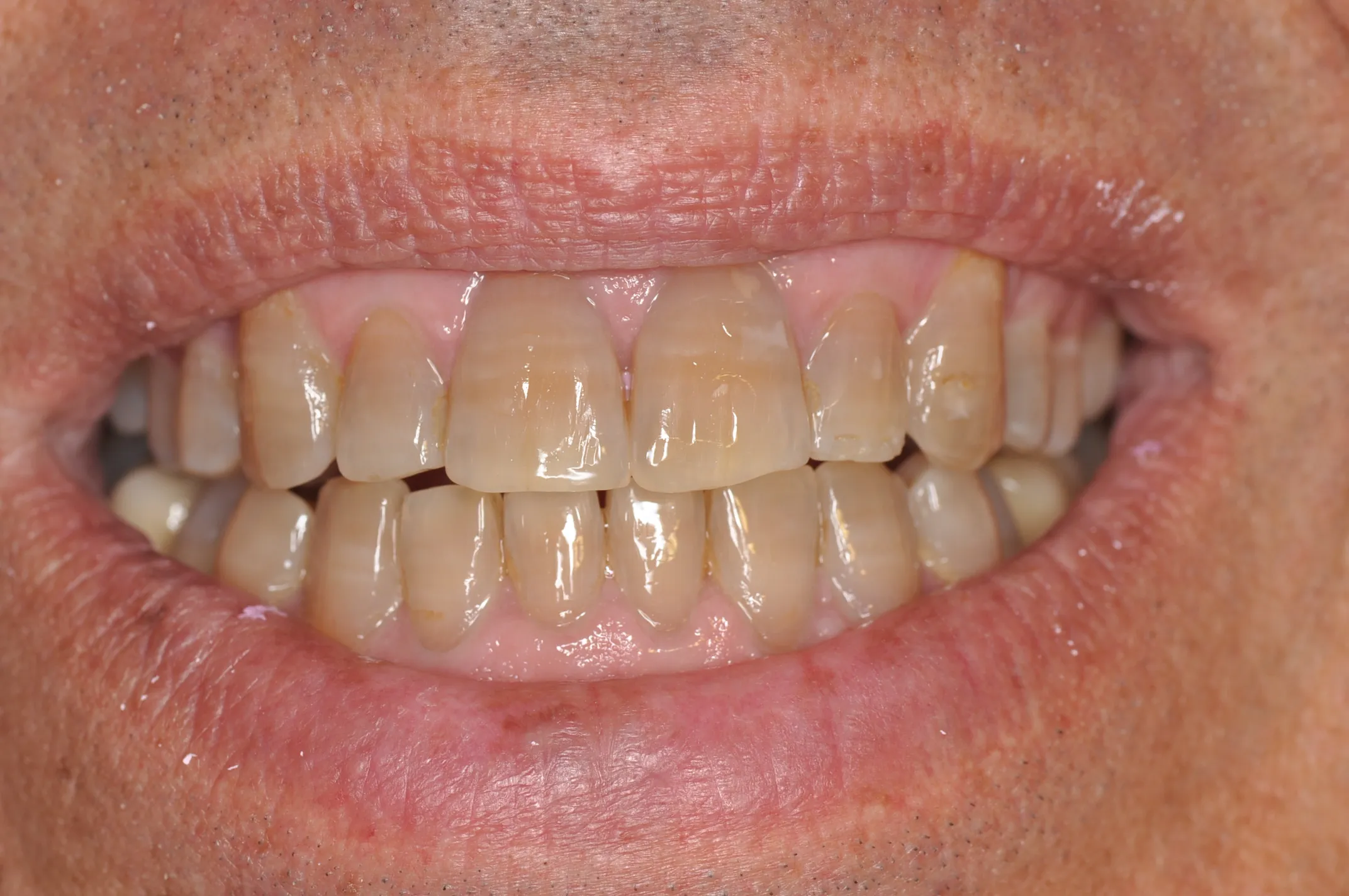 25456 teeth whitening options