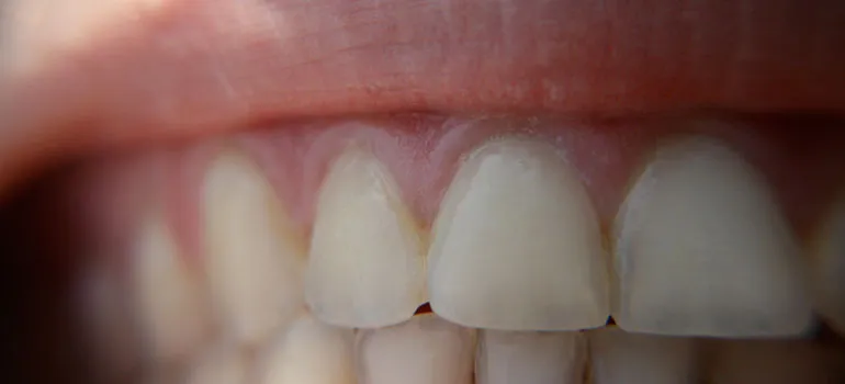 25458 tooth enamel