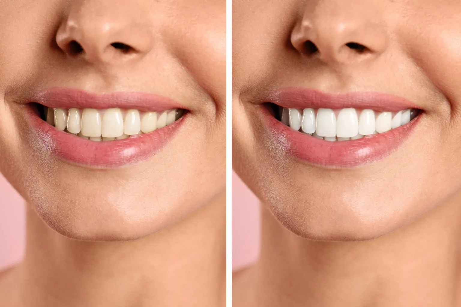 25465 at home whitening kits