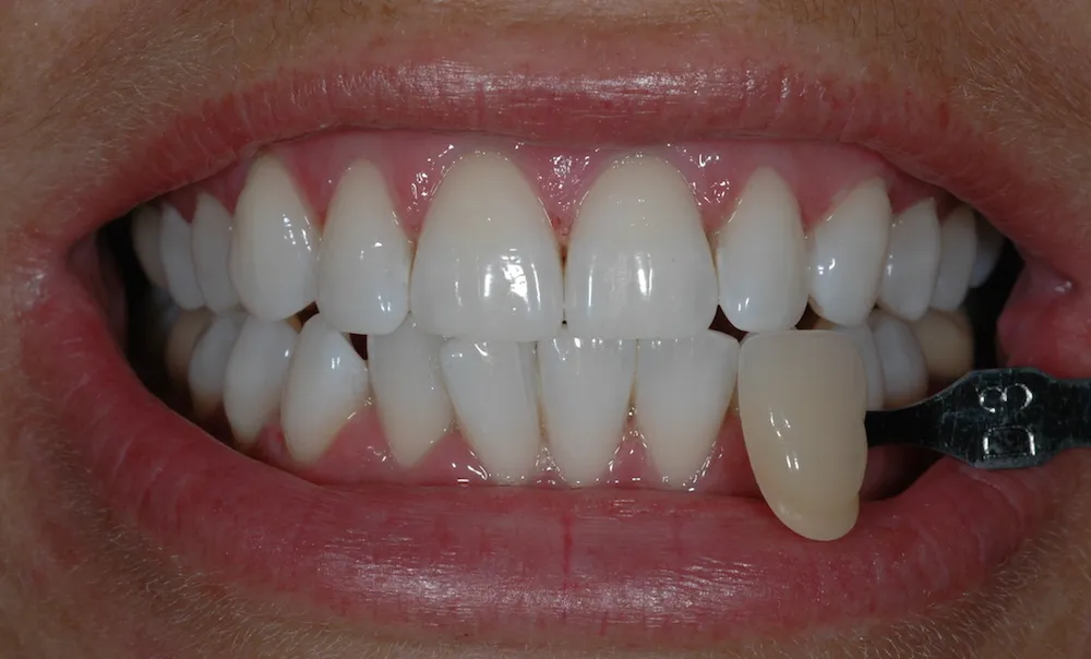 25465 dental bonding