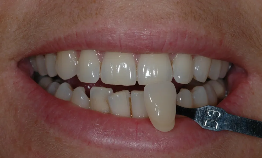 25465 dental veneers
