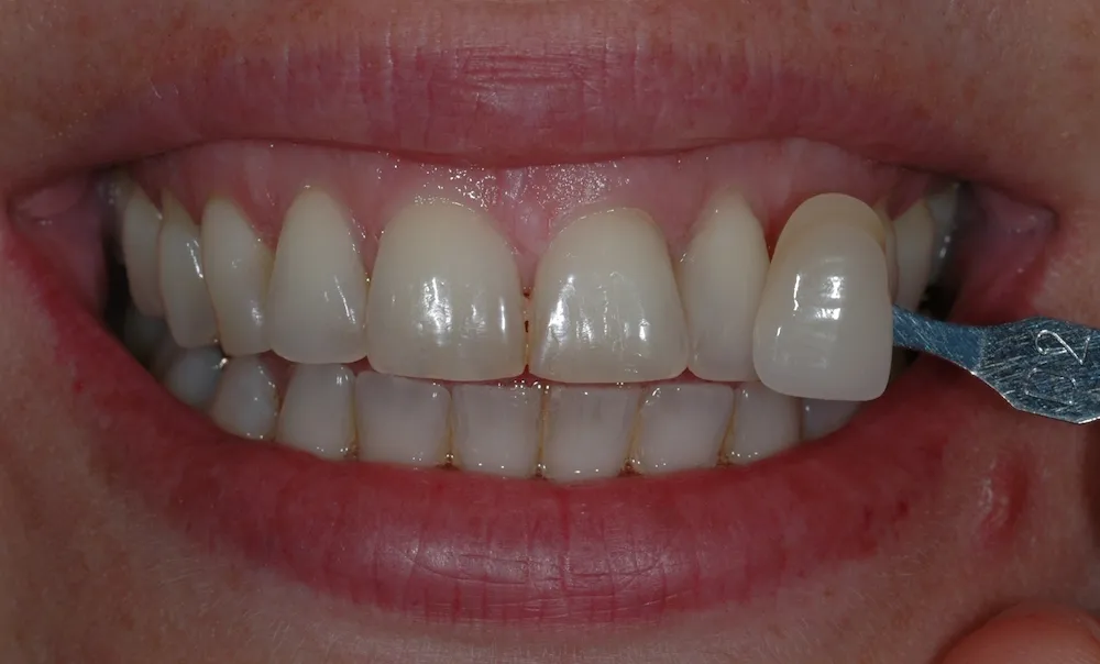 25465 teeth whitening strips