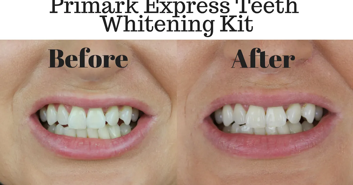 /img/25467-teeth-whitening-cost.webp