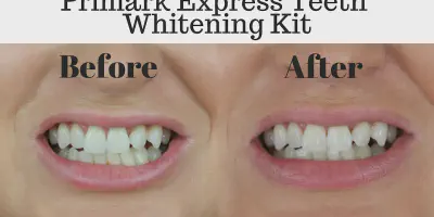 /img/25467-teeth-whitening-cost.webp