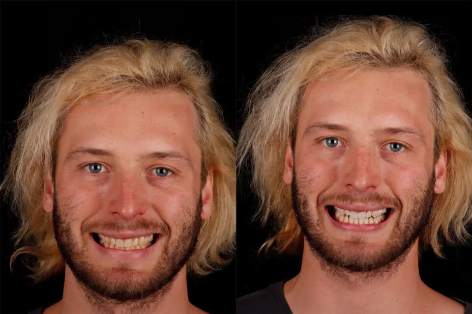 25472 humble teeth whitening results