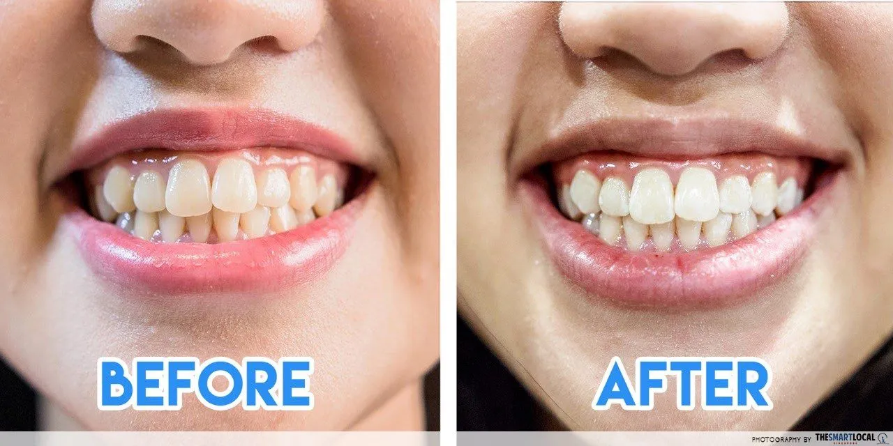 25482 follow up appointment teeth whitening