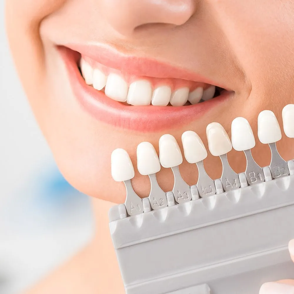 25485 teeth whitening options