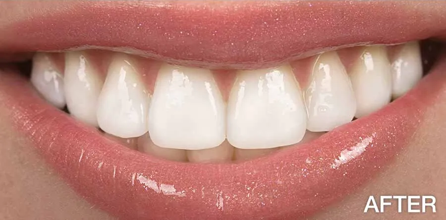 25485 teeth whitening process