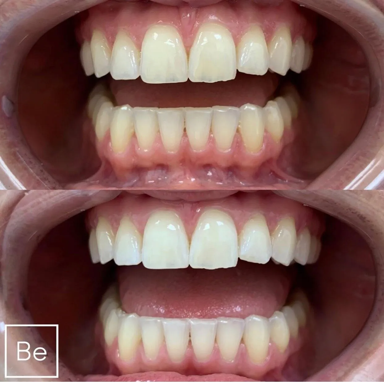 25489 professional teeth whitening