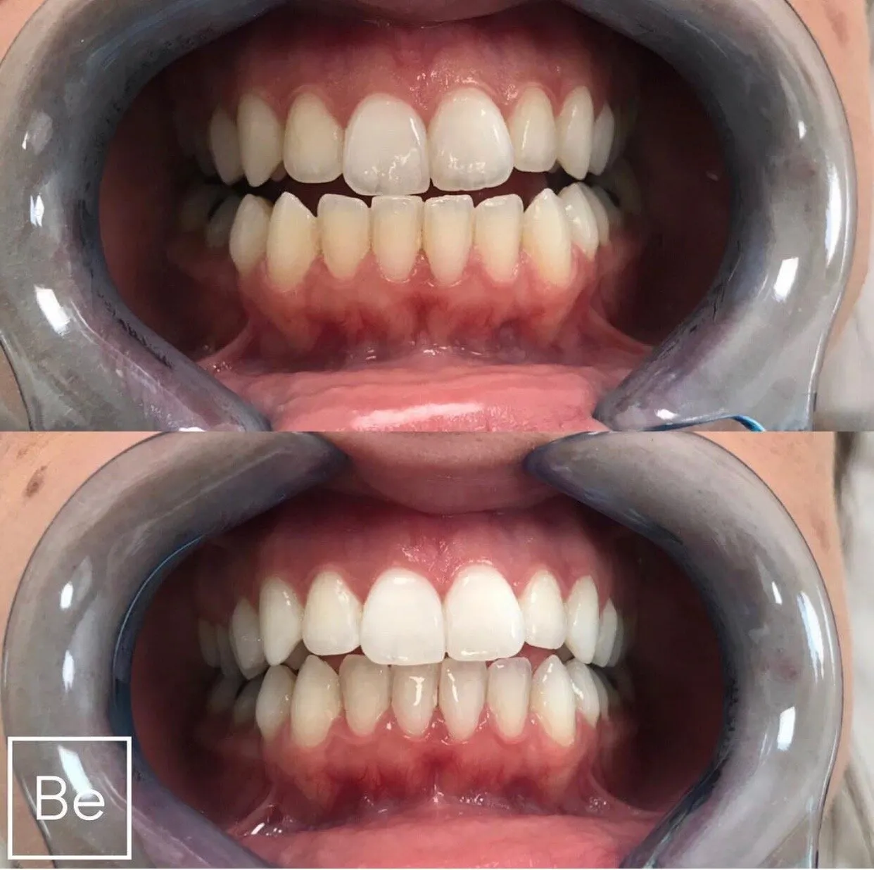 25489 teeth whitening aftercare