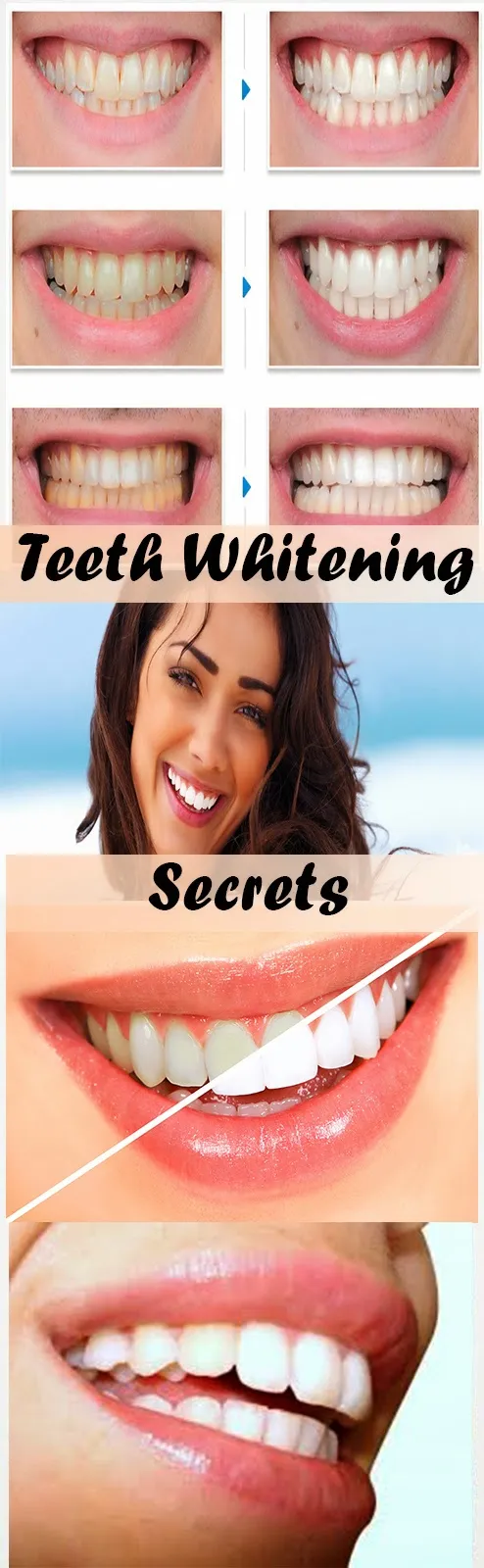 25491 home teeth whitening kits