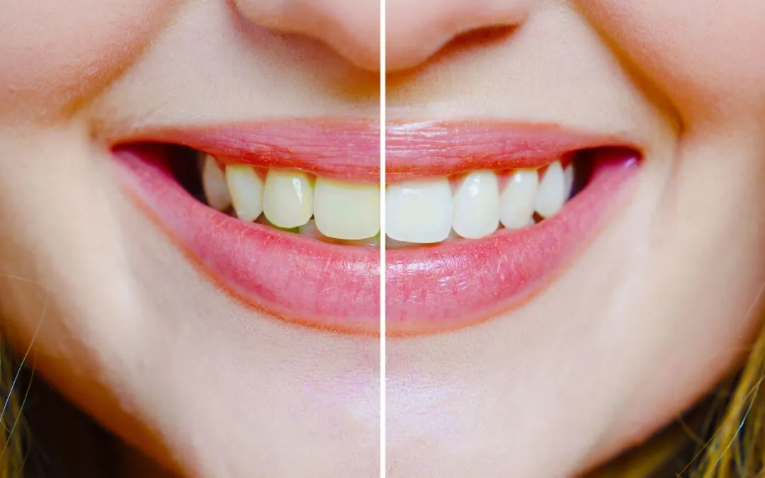 /img/25491-teeth-whitening-candidates.webp