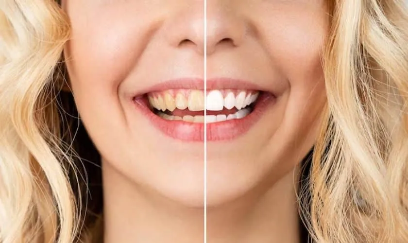 25491 types of home whitening