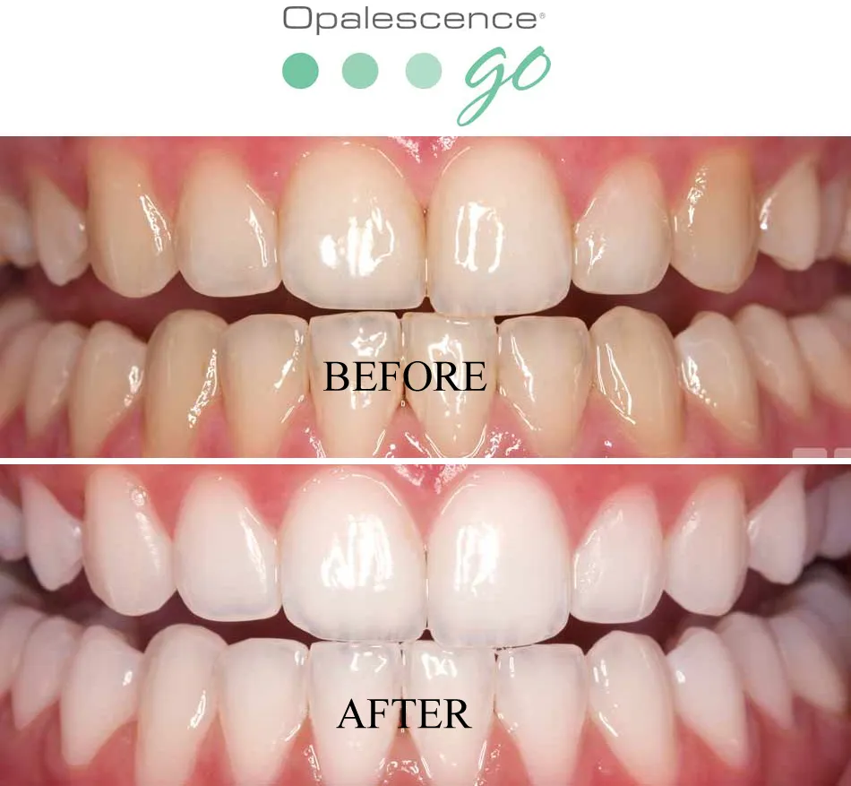 25498 opalescence teeth whitening procedure