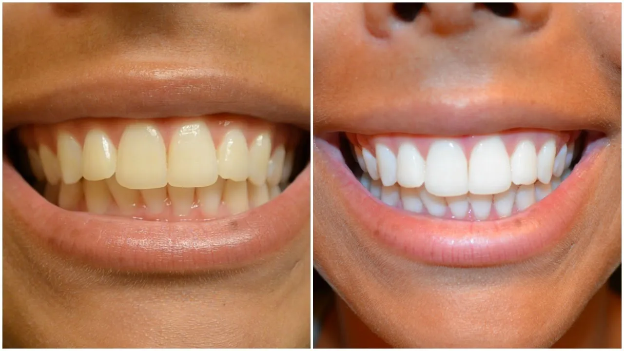 25504 teeth before after whitening