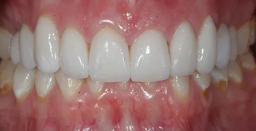 25506 foods to avoid after whitening