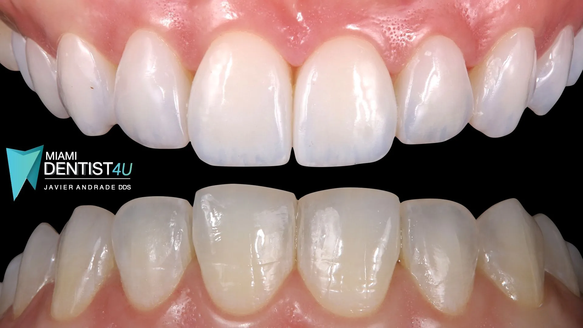 25508 professional teeth whitening miami