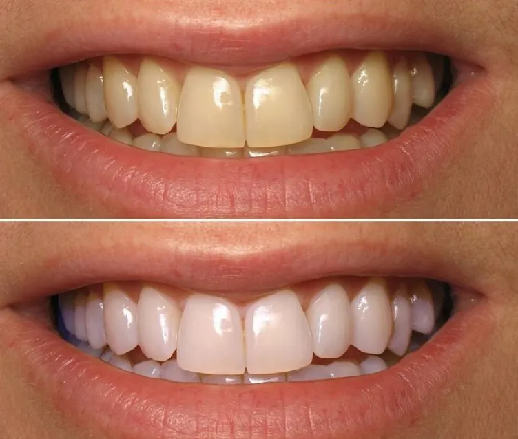 25511 teeth whitening alternatives