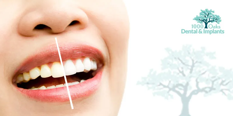 25511 teeth whitening strips application