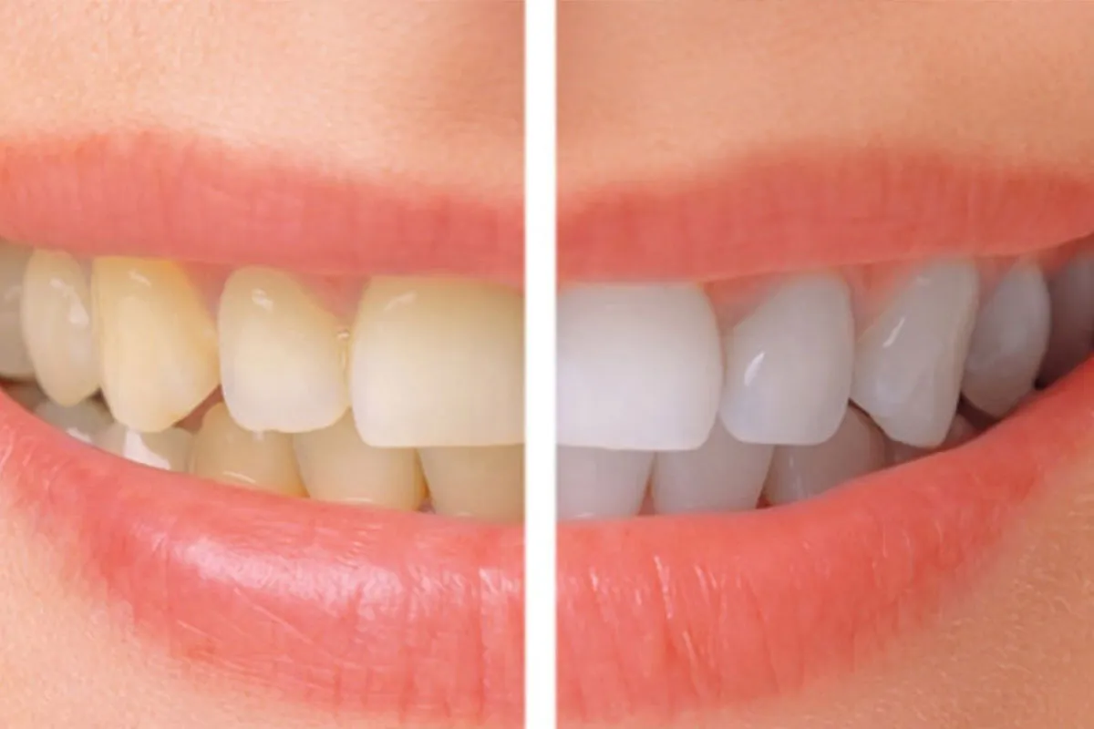 25515 teeth whitening process