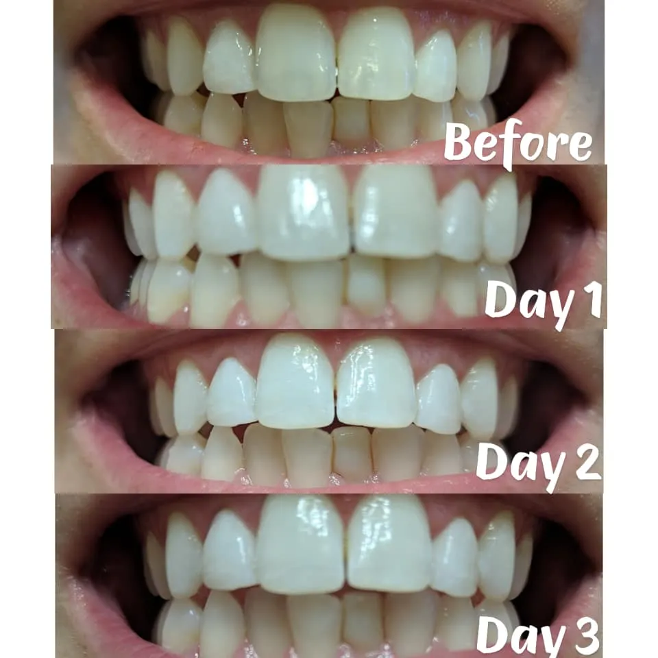 25521 carbamide peroxide teeth whitening