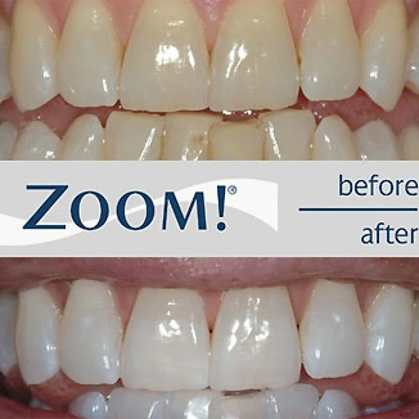 25526 zoom whitening vs laser