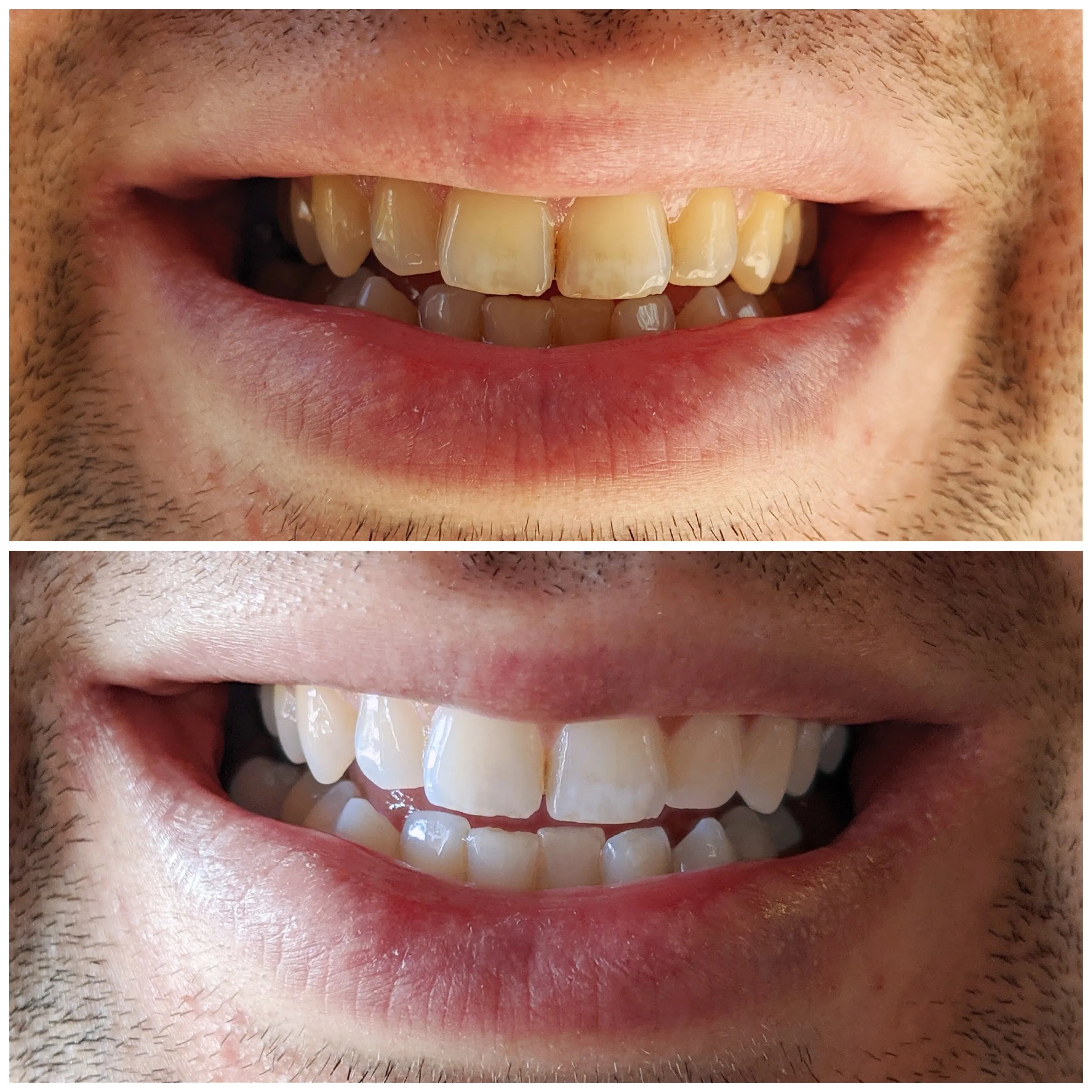 25533 healthy smile teeth whitening