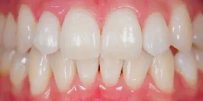 /img/25539-teeth-whitening-johannesburg-cost-options.webp