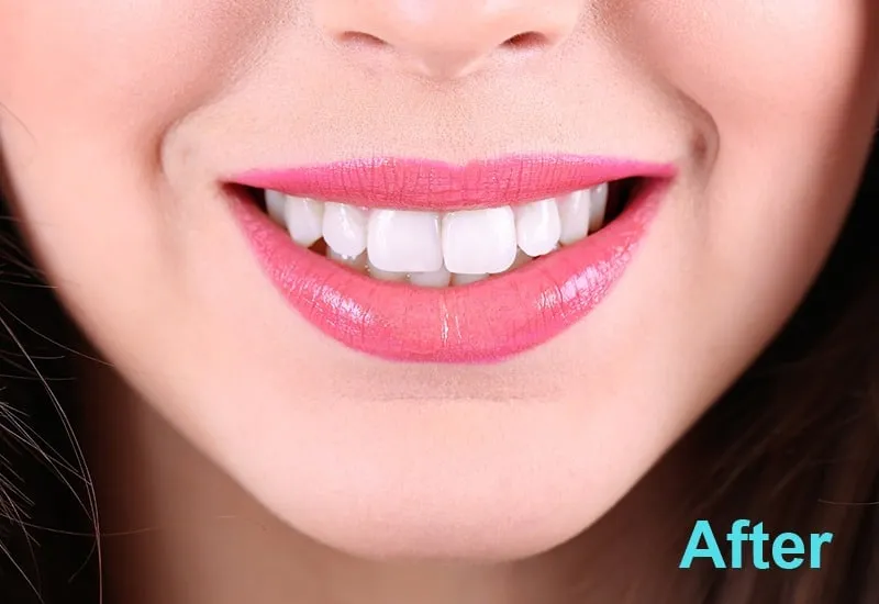 25539 teeth whitening johannesburg in office