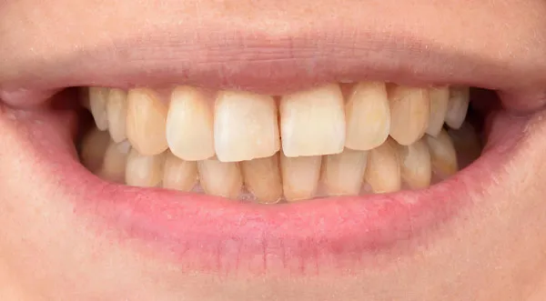 25541 teeth whitening treatment options
