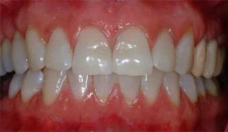 25542 take home whitening