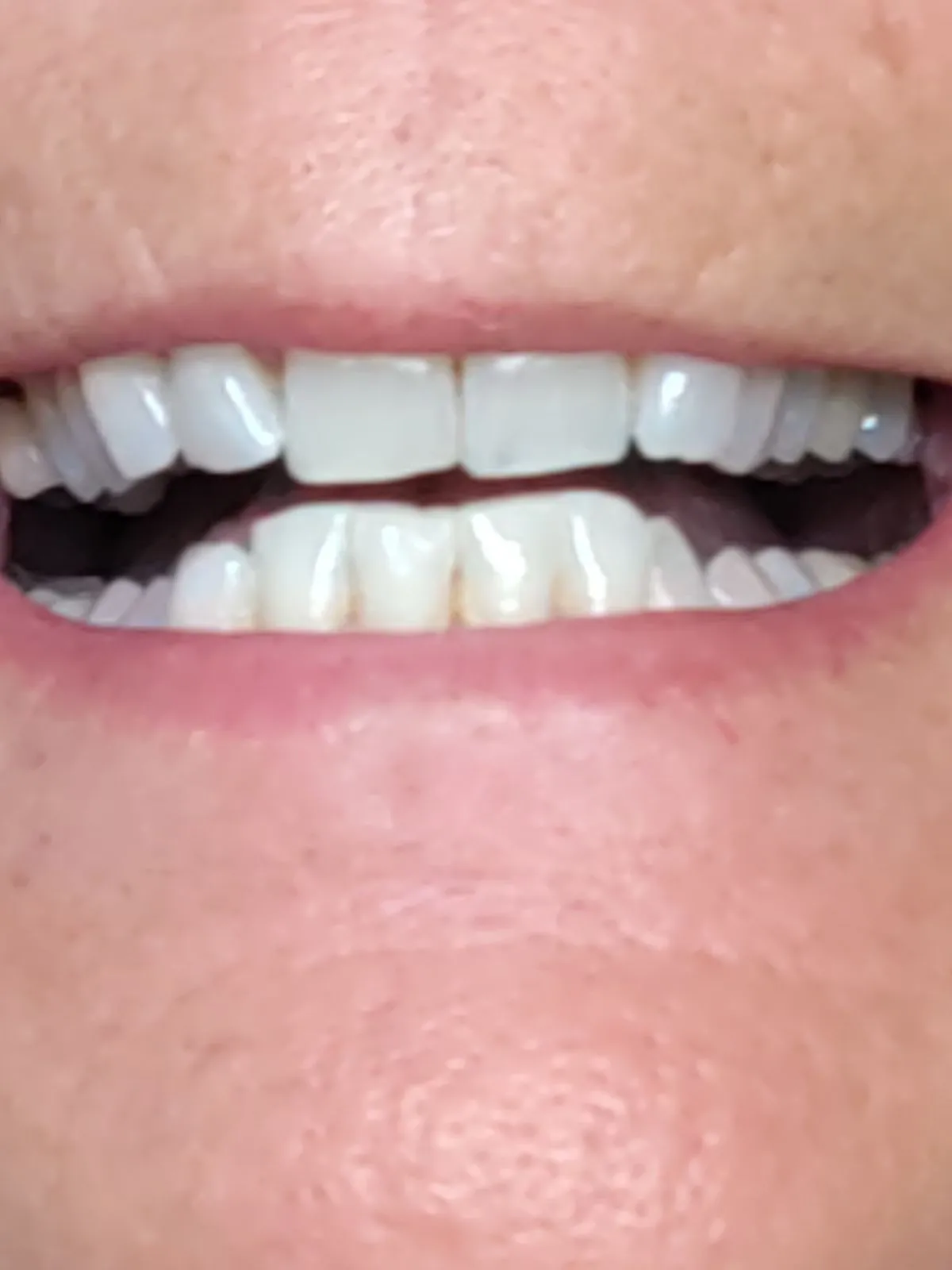 25544 teeth whitening results