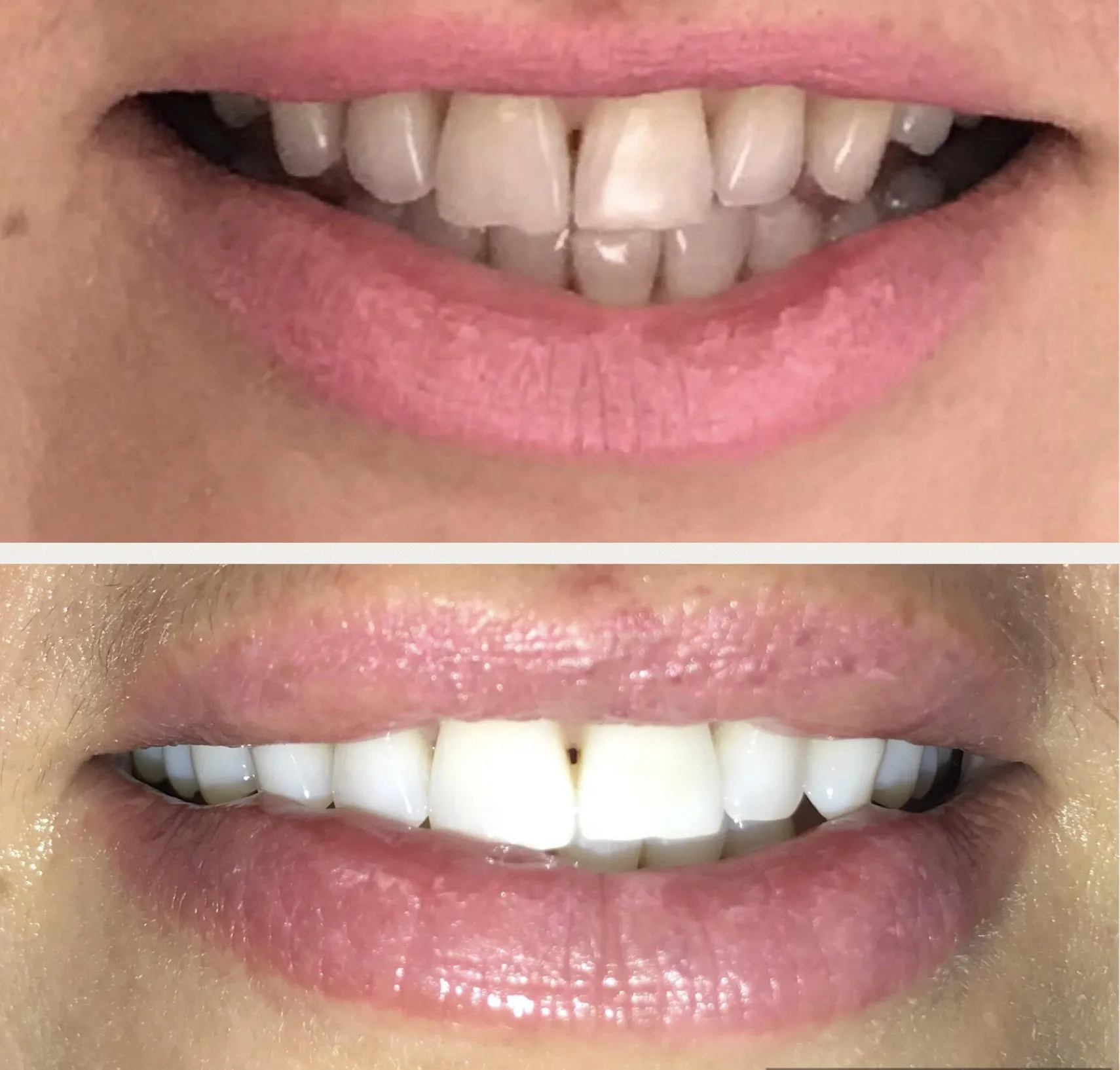 25552 professional teeth whitening