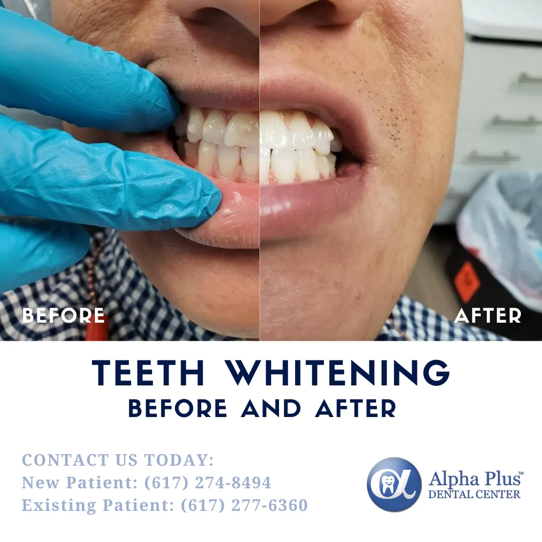 25558 teeth whitening professional
