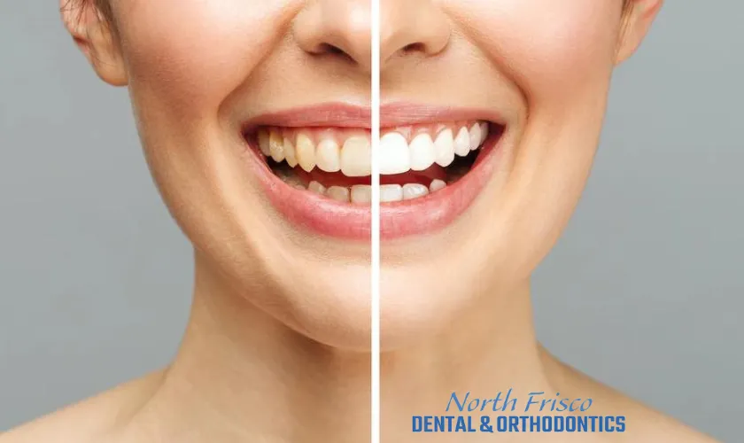 25558 teeth whitening treatment