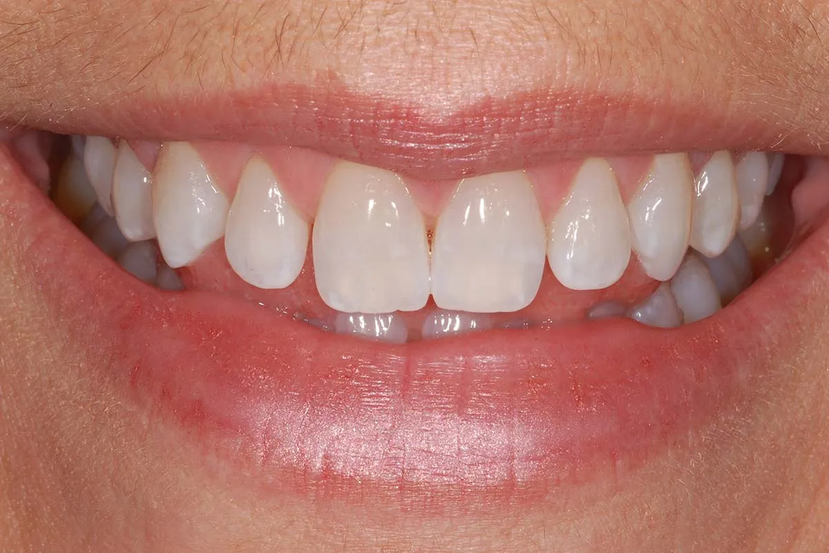 25562 kor whitening process