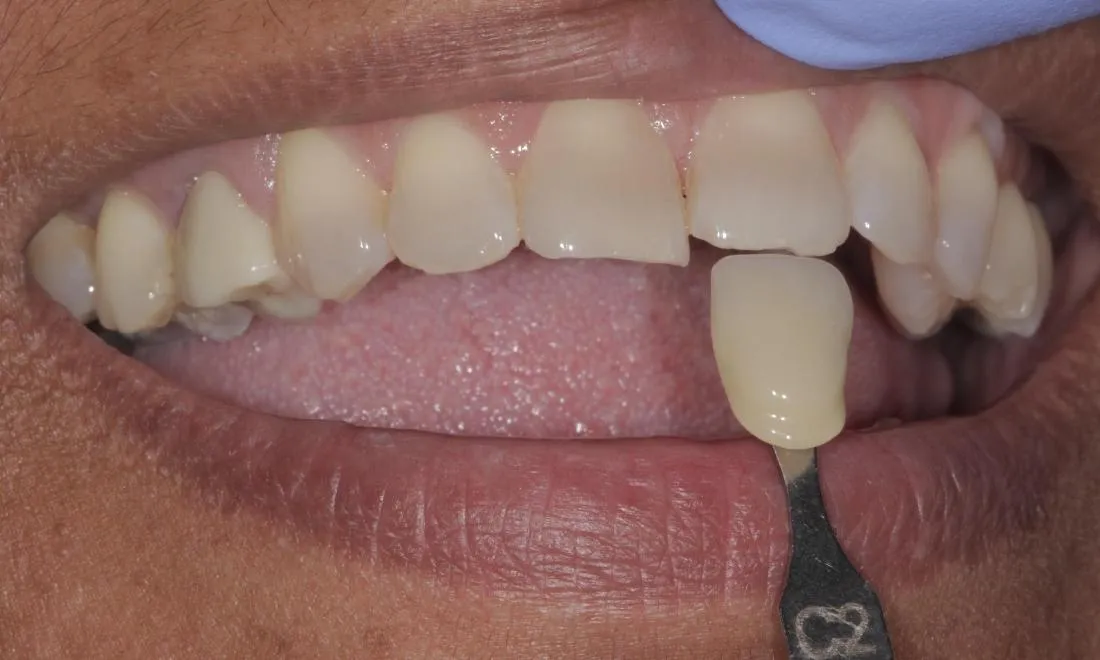 25562 teeth whitening comparison