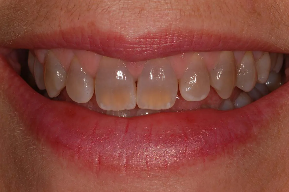 25562 tetracycline stain types