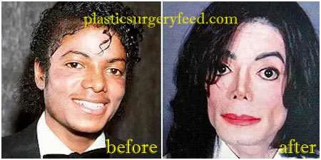 25565 michael jackson vitiligo