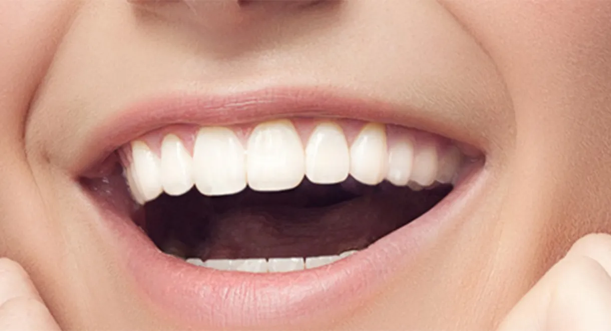 25566 teeth whitening kitchener professional