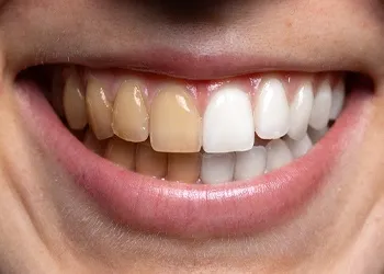 25567 professional teeth whitening