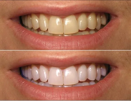25577 coconut oil teeth whitening 4