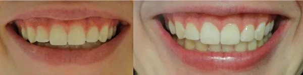 25584 charcoal teeth whitening application